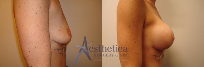 Breast Augmentation Case 376 Before & After View #5 | Columbus, OH | Aesthetica Surgery & Spa