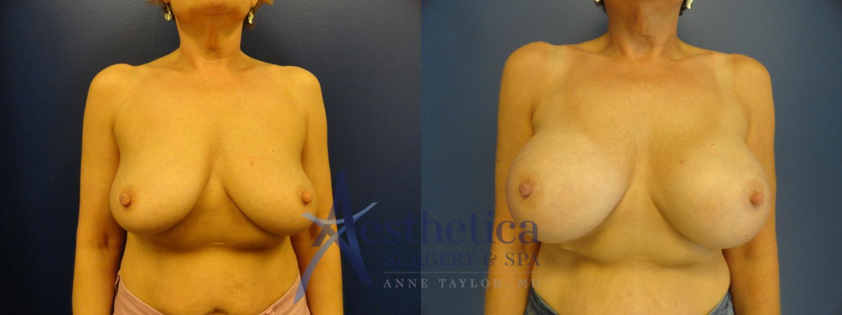 Breast Augmentation Case 377 Before & After View #1 | Columbus, OH | Aesthetica Surgery & Spa