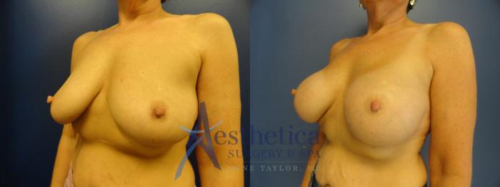 Breast Augmentation Case 377 Before & After View #2 | Columbus, OH | Aesthetica Surgery & Spa