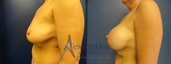 Breast Augmentation Case 377 Before & After View #3 | Columbus, OH | Aesthetica Surgery & Spa