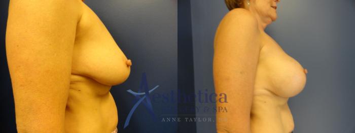 Breast Augmentation Case 377 Before & After View #4 | Columbus, OH | Aesthetica Surgery & Spa