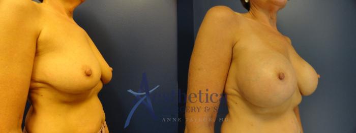 Breast Augmentation Case 377 Before & After View #5 | Columbus, OH | Aesthetica Surgery & Spa