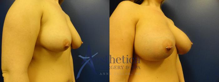 Breast Augmentation Case 378 Before & After View #2 | Columbus, OH | Aesthetica Surgery & Spa