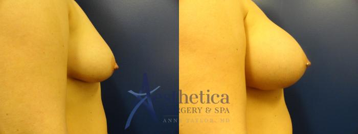 Breast Augmentation Case 378 Before & After View #3 | Columbus, OH | Aesthetica Surgery & Spa