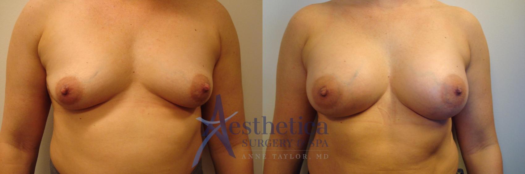 Breast Augmentation Case 379 Before & After View #1 | Worthington, OH | Aesthetica Surgery & Spa