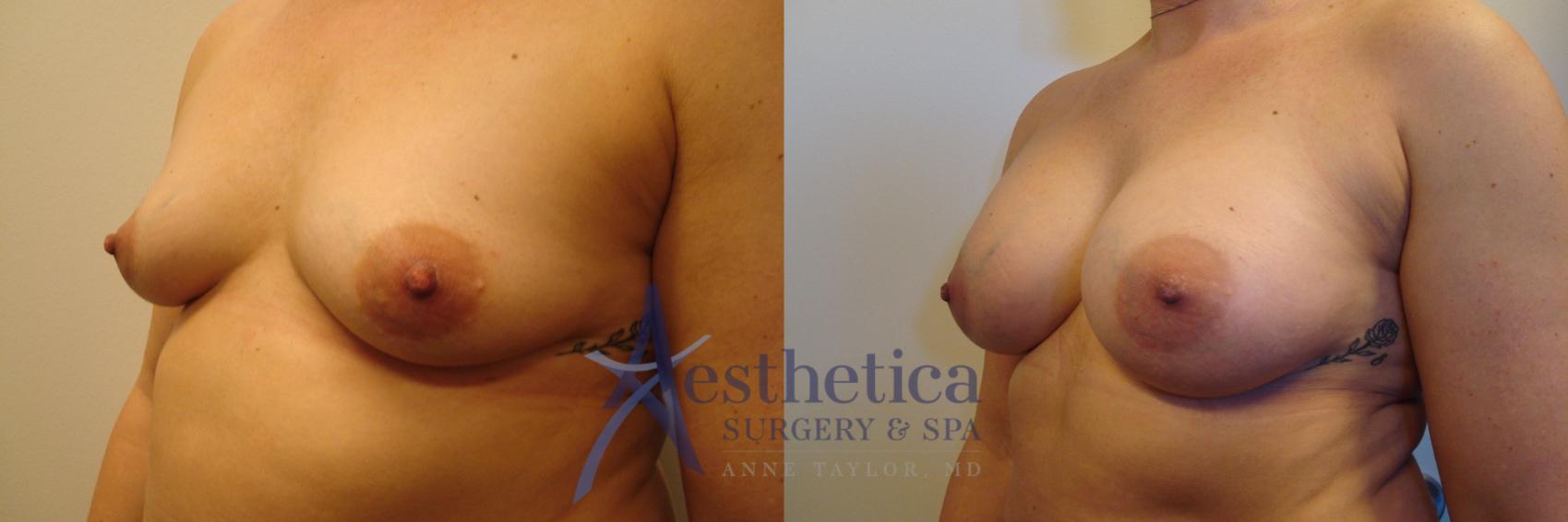 Breast Augmentation Case 379 Before & After View #2 | Worthington, OH | Aesthetica Surgery & Spa