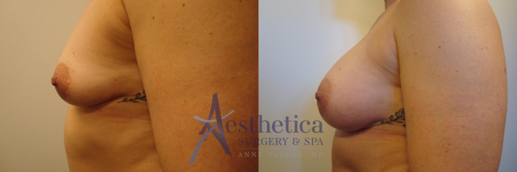 Breast Augmentation Case 379 Before & After View #3 | Worthington, OH | Aesthetica Surgery & Spa