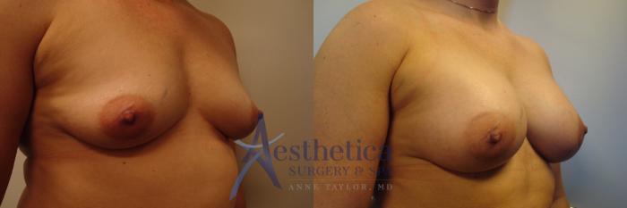 Breast Augmentation Case 379 Before & After View #4 | Columbus, OH | Aesthetica Surgery & Spa