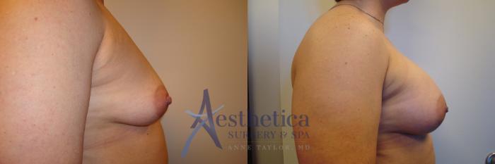 Breast Augmentation Case 379 Before & After View #5 | Columbus, OH | Aesthetica Surgery & Spa