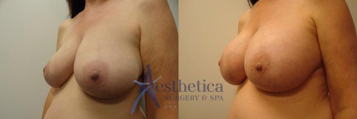 Breast Augmentation Case 380 Before & After View #2 | Columbus, OH | Aesthetica Surgery & Spa