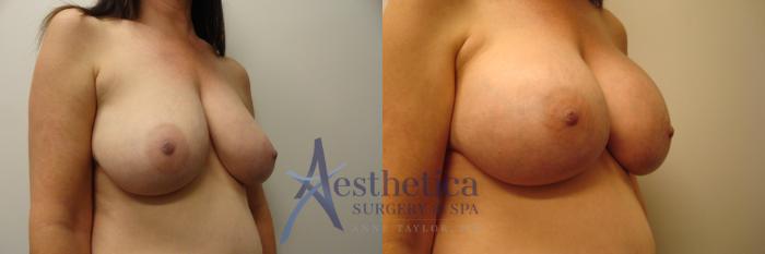 Breast Augmentation Case 380 Before & After View #3 | Columbus, OH | Aesthetica Surgery & Spa