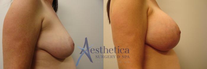 Breast Augmentation Case 380 Before & After View #4 | Columbus, OH | Aesthetica Surgery & Spa