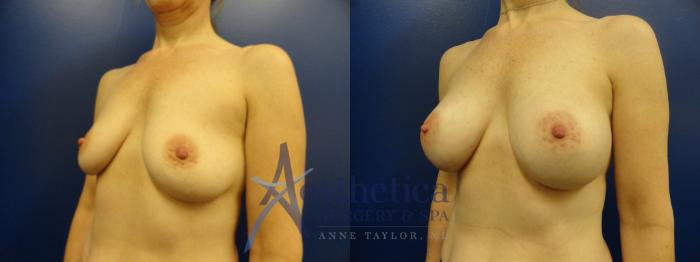 Breast Augmentation Case 381 Before & After View #2 | Columbus, OH | Aesthetica Surgery & Spa