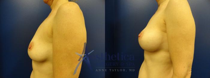 Breast Augmentation Case 381 Before & After View #3 | Columbus, OH | Aesthetica Surgery & Spa