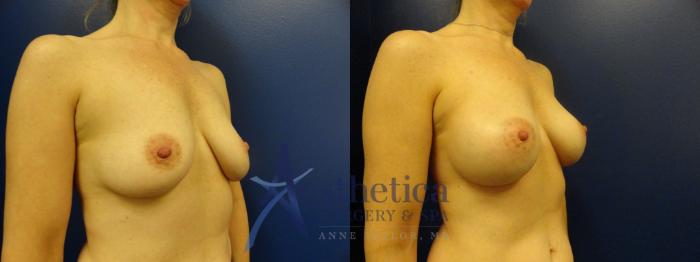 Breast Augmentation Case 381 Before & After View #4 | Columbus, OH | Aesthetica Surgery & Spa