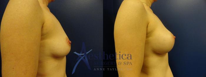 Breast Augmentation Case 381 Before & After View #5 | Columbus, OH | Aesthetica Surgery & Spa