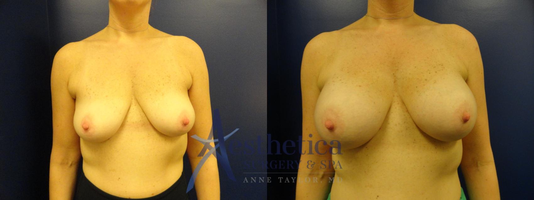 Breast Augmentation Case 382 Before & After View #1 | Columbus, OH | Aesthetica Surgery & Spa