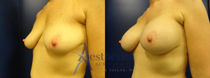 Breast Augmentation Case 382 Before & After View #2 | Columbus, OH | Aesthetica Surgery & Spa