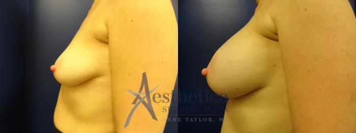 Breast Augmentation Case 382 Before & After View #3 | Columbus, OH | Aesthetica Surgery & Spa