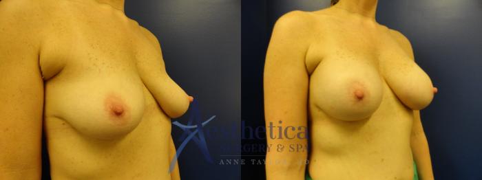 Breast Augmentation Case 382 Before & After View #4 | Columbus, OH | Aesthetica Surgery & Spa