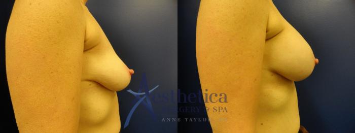 Breast Augmentation Case 382 Before & After View #5 | Columbus, OH | Aesthetica Surgery & Spa