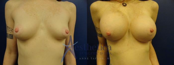 Breast Augmentation Case 383 Before & After View #1 | Columbus, OH | Aesthetica Surgery & Spa