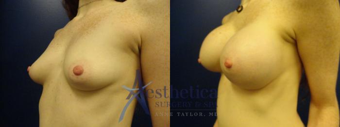 Breast Augmentation Case 383 Before & After View #2 | Columbus, OH | Aesthetica Surgery & Spa