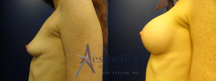Breast Augmentation Case 383 Before & After View #3 | Columbus, OH | Aesthetica Surgery & Spa