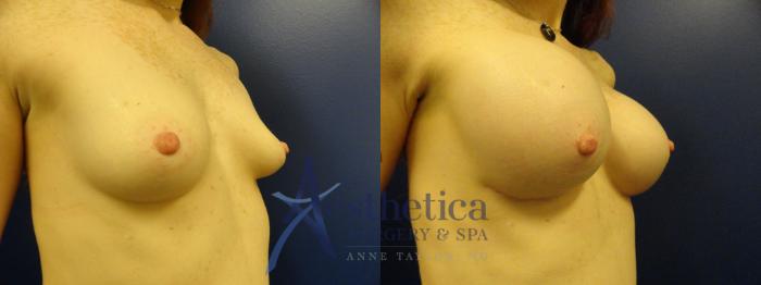 Breast Augmentation Case 383 Before & After View #4 | Columbus, OH | Aesthetica Surgery & Spa