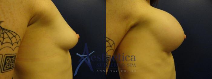 Breast Augmentation Case 383 Before & After View #5 | Columbus, OH | Aesthetica Surgery & Spa