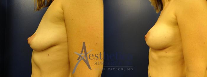 Breast Augmentation Case 384 Before & After View #3 | Columbus, OH | Aesthetica Surgery & Spa