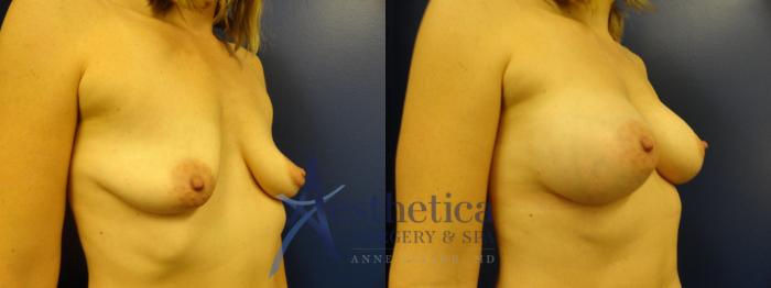 Breast Augmentation Case 384 Before & After View #4 | Columbus, OH | Aesthetica Surgery & Spa