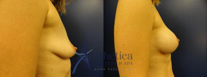 Breast Augmentation Case 384 Before & After View #5 | Columbus, OH | Aesthetica Surgery & Spa