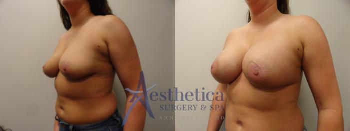 Breast Augmentation Case 385 Before & After View #2 | Columbus, OH | Aesthetica Surgery & Spa