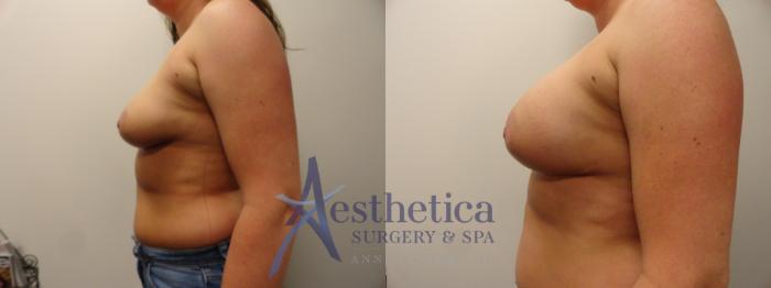 Breast Augmentation Case 385 Before & After View #3 | Columbus, OH | Aesthetica Surgery & Spa