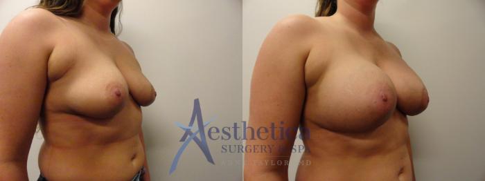 Breast Augmentation Case 385 Before & After View #4 | Columbus, OH | Aesthetica Surgery & Spa