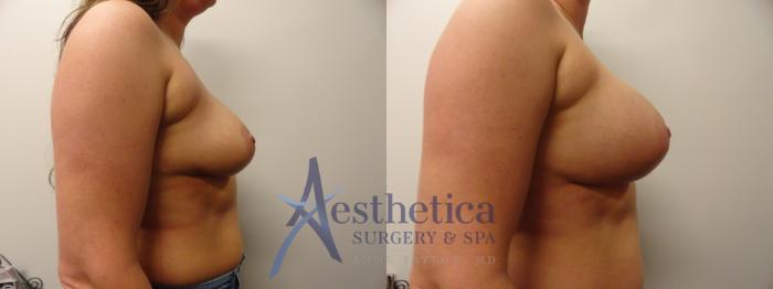 Breast Augmentation Case 385 Before & After View #5 | Columbus, OH | Aesthetica Surgery & Spa