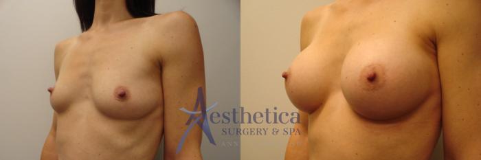 Breast Augmentation Case 386 Before & After View #2 | Columbus, OH | Aesthetica Surgery & Spa