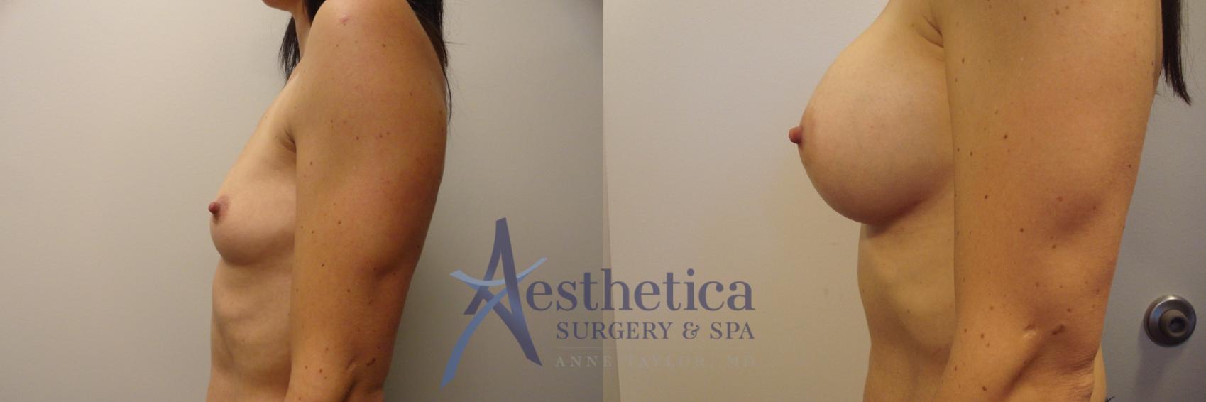 Breast Augmentation Case 386 Before & After View #3 | Columbus, OH | Aesthetica Surgery & Spa
