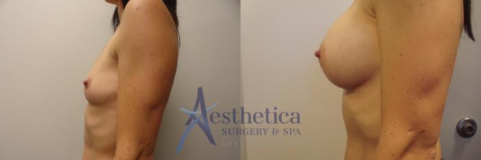 Breast Augmentation Case 386 Before & After View #3 | Columbus, OH | Aesthetica Surgery & Spa