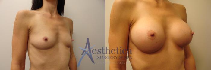 Breast Augmentation Case 386 Before & After View #4 | Columbus, OH | Aesthetica Surgery & Spa
