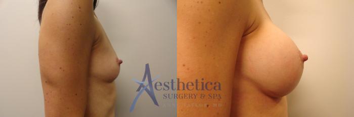 Breast Augmentation Case 386 Before & After View #5 | Columbus, OH | Aesthetica Surgery & Spa