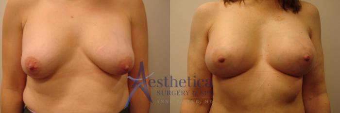 Breast Augmentation Case 387 Before & After View #1 | Columbus, OH | Aesthetica Surgery & Spa