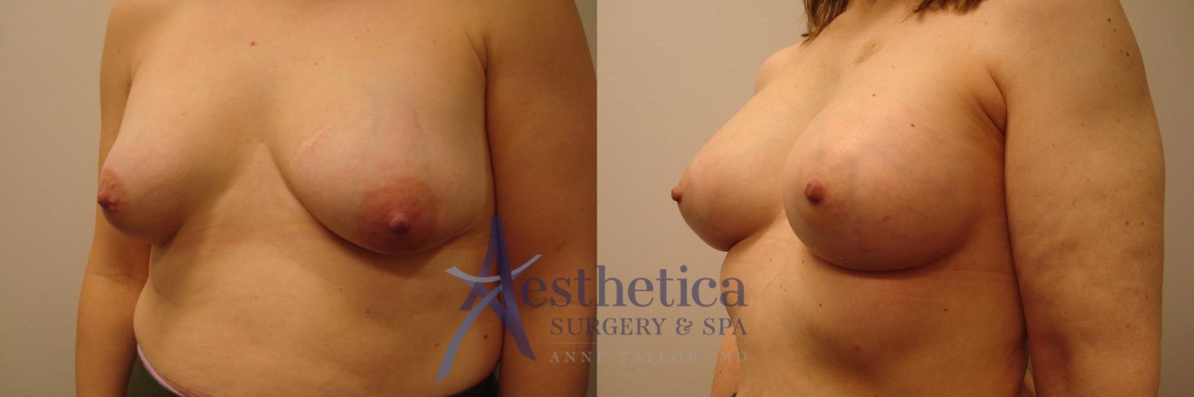 Breast Augmentation Case 387 Before & After View #2 | Worthington, OH | Aesthetica Surgery & Spa