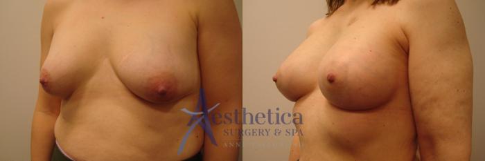 Breast Augmentation Case 387 Before & After View #2 | Columbus, OH | Aesthetica Surgery & Spa