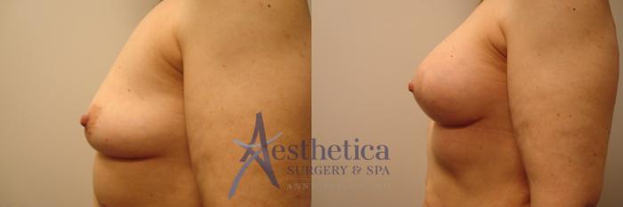 Breast Augmentation Case 387 Before & After View #3 | Columbus, OH | Aesthetica Surgery & Spa