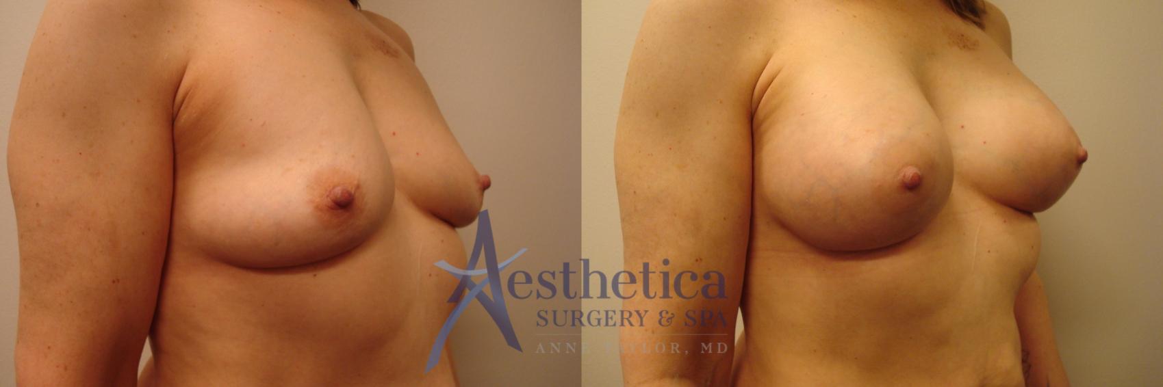 Breast Augmentation Case 387 Before & After View #4 | Worthington, OH | Aesthetica Surgery & Spa