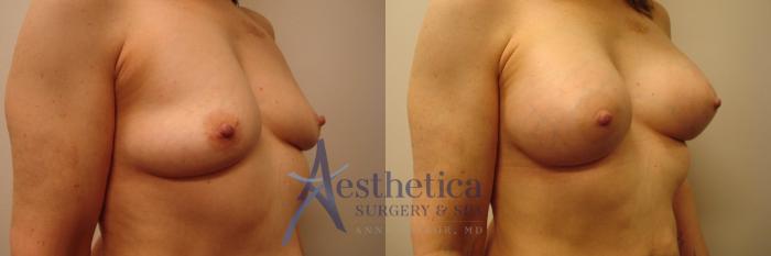 Breast Augmentation Case 387 Before & After View #4 | Columbus, OH | Aesthetica Surgery & Spa