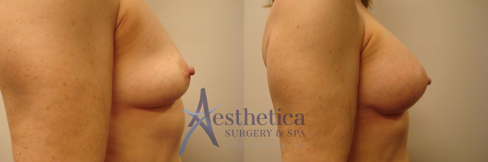 Breast Augmentation Case 387 Before & After View #5 | Worthington, OH | Aesthetica Surgery & Spa