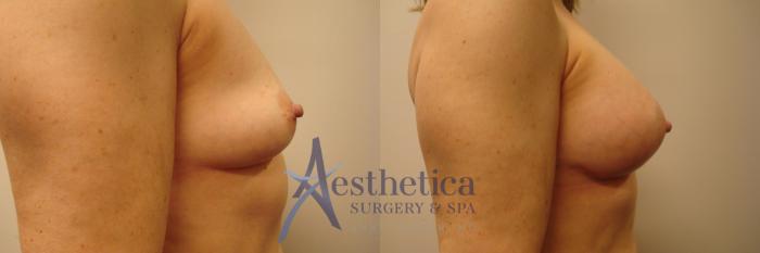 Breast Augmentation Case 387 Before & After View #5 | Columbus, OH | Aesthetica Surgery & Spa